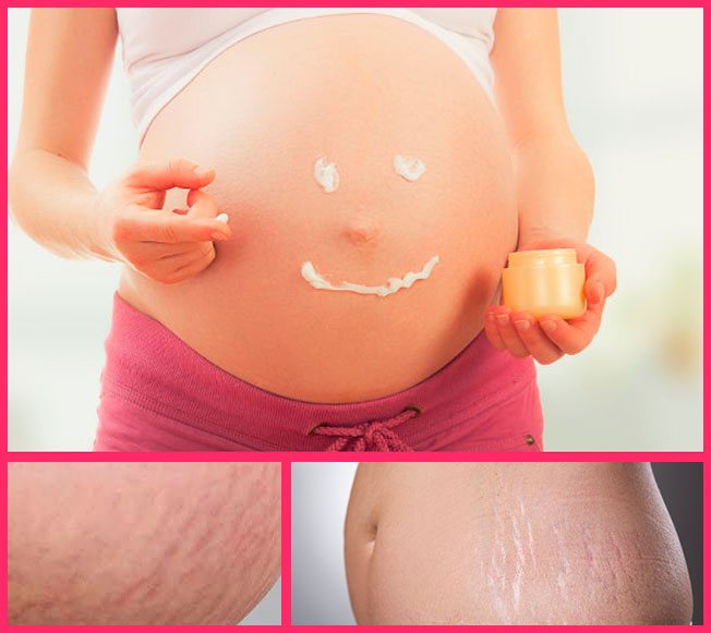 Effective anti-stretch marks cream in pregnancy - 2022