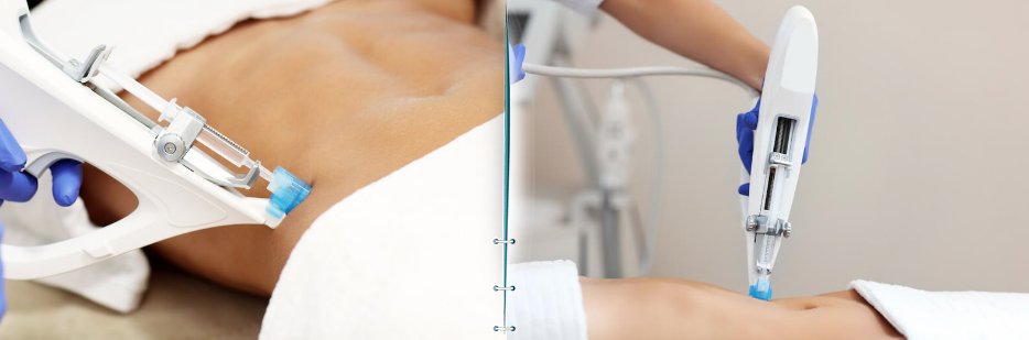 Mesotherapy for stretch marks