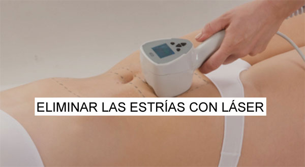 eliminar estrias laser