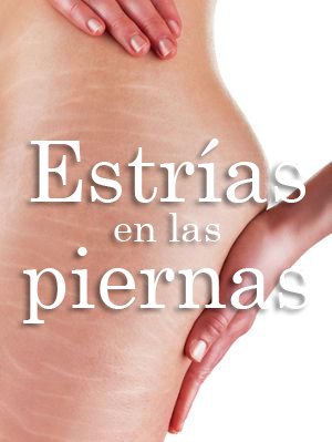 Estrias en las piernas